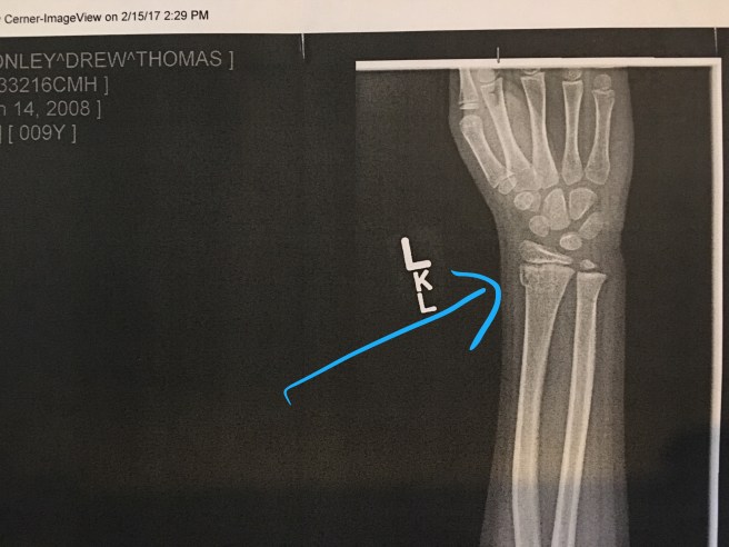 2.15.17 Drew Left Wrist Fracture.jpg